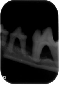 Kuva 1. Vasemmalla röntgenkuva Chilin terveestä alaleukaluusta. Vrt. oikeanpuolimmaiseen kuvaan